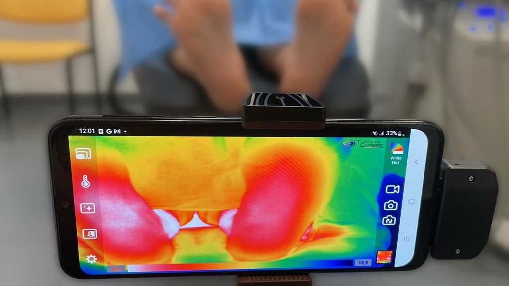 Clinicgram crea una app de IA para prevenir amputaciones por pie diabético