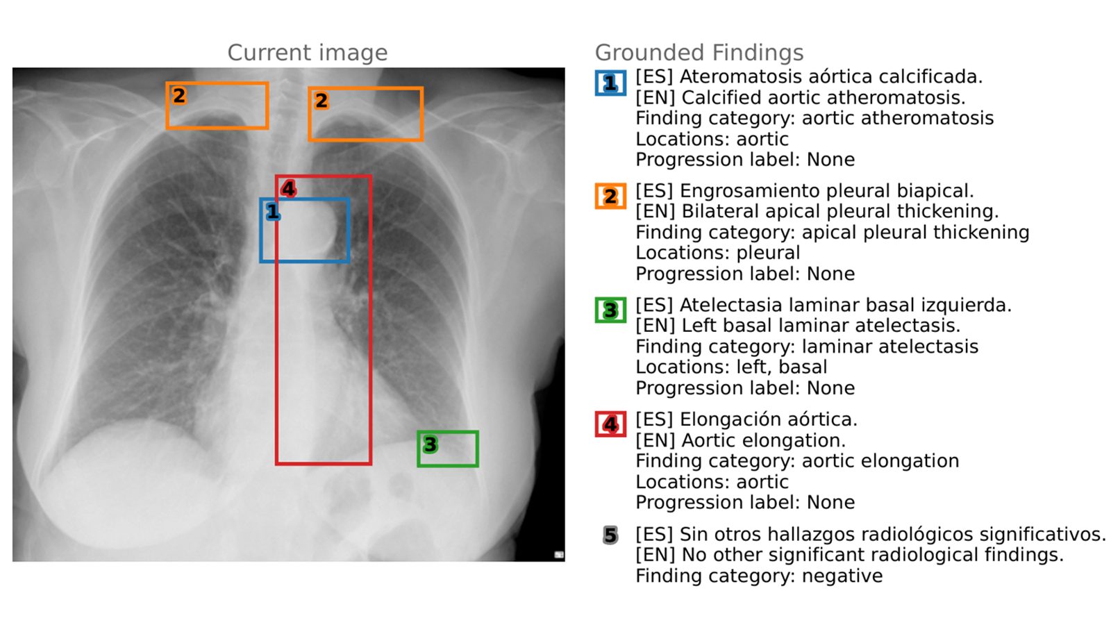 Javier Álvarez‑Valle: la mente española al frente de la IA transparente en radiología